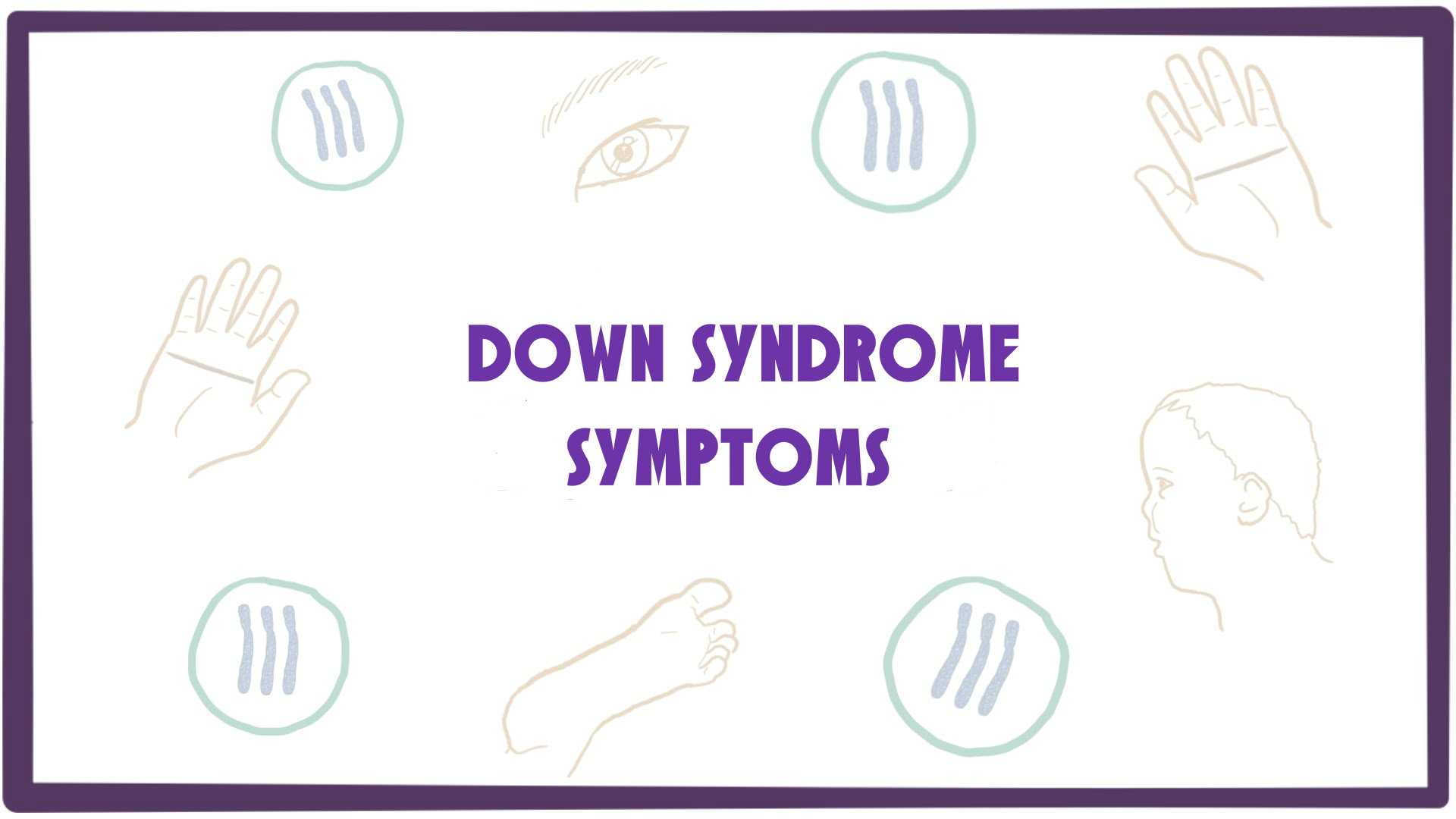 Common symptoms of Down Syndrome